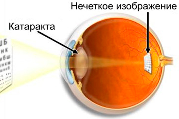 Основное о катаракте