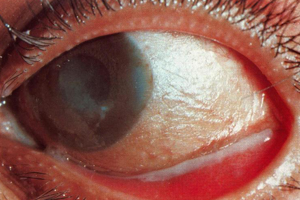 brzheskiy-vv-dry-eye-clinical-signs-portal-organum-visus-43