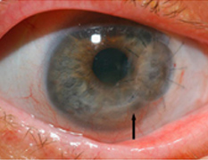 Отслоение и дегенерация сетчатки глаза