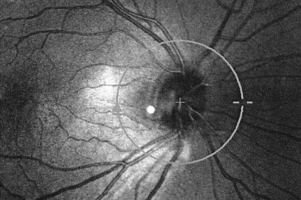 Оптическая когерентная ретинальная томография